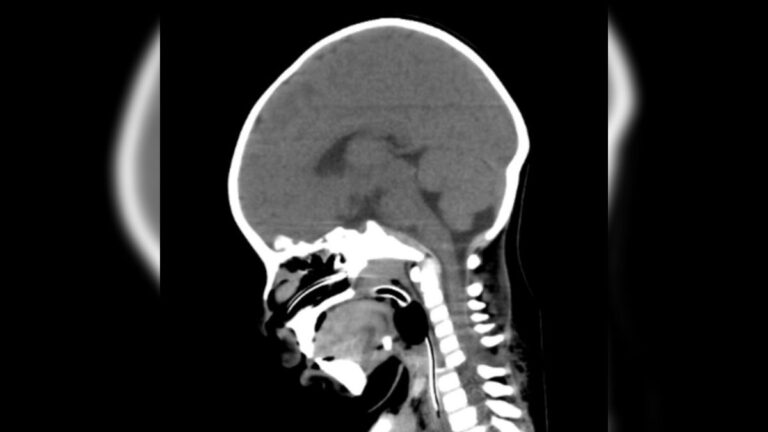 Un bebé jujeño de 6 meses fue salvado gracias a una compleja cirugía en Santiago del Estero