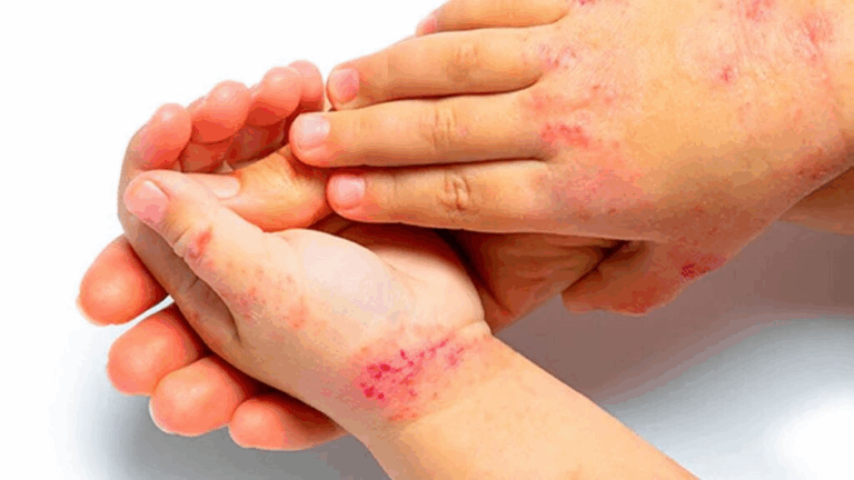 Campaña de detección gratuita de dermatitis atópica